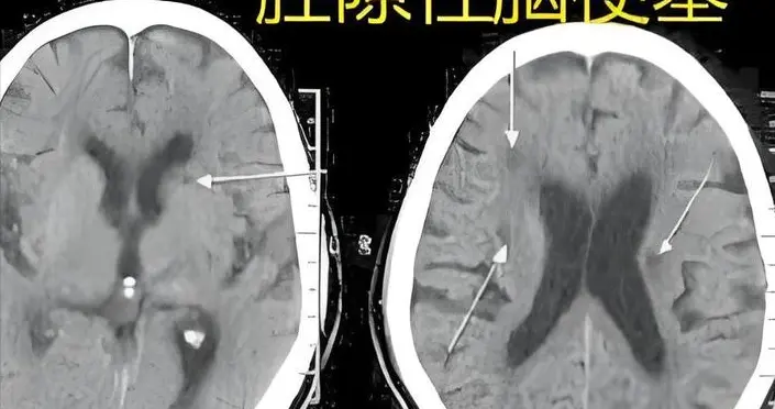 体检查出腔隙性脑梗死，用治疗吗？出现4种情况，需要用药！
