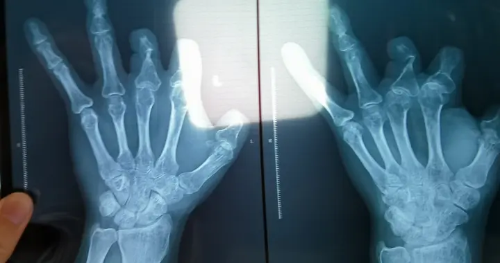 郑大一附院医生诈骗94名患者：手术器材如何成为灰色利益工具