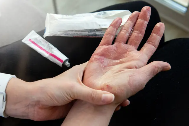 理解慢性手部湿疹：细胞机制与治疗意义