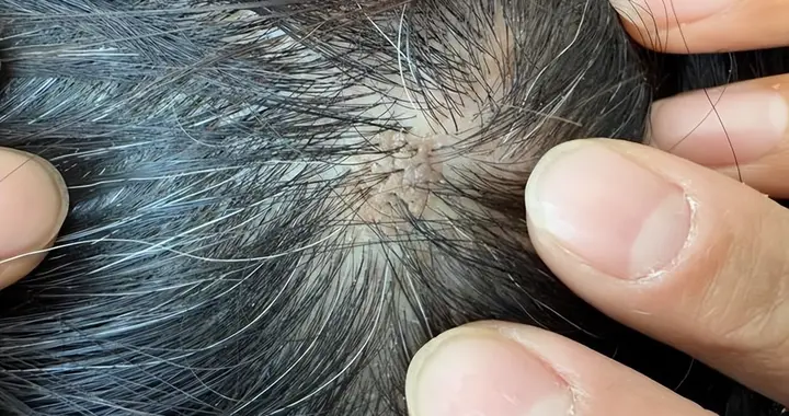 头皮上总是长疙瘩和脓包？医生提醒：要警惕，很可能是这3种疾病