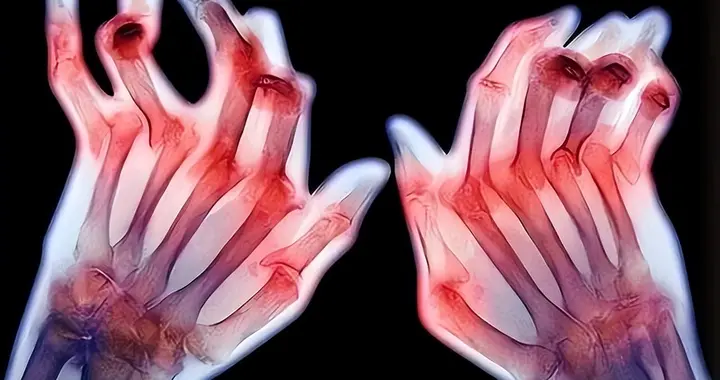 网上疯传的“特效药”真能让类风湿断根吗？听听大夫到底怎么说