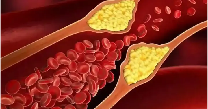 肠道菌群调理：降血脂的隐形助手？