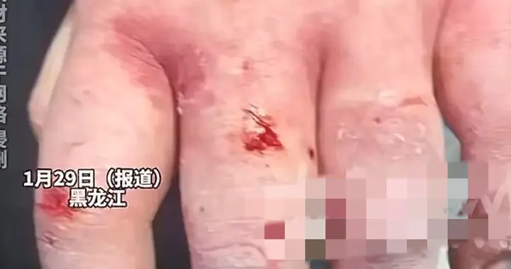 女大学生东北游玩晕倒雪地面临三根手指截肢，东北的冷不是开玩笑