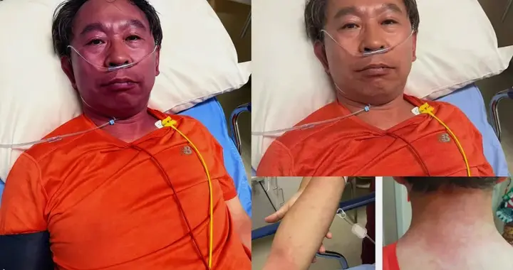 协和妇产科教授头孢过敏休克，一线救命药肾上腺素为何没用上？