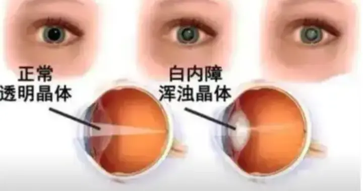 上海眼科院长：白内障手术时机：别等“熟了”，视生活质量而定