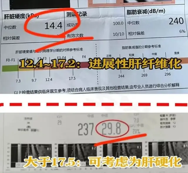 肝硬度检查肝脏的“硬度”“弹性”，4类人不建议做这项检查！