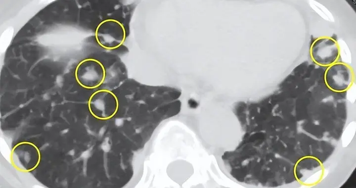 肺结节开始癌变，身体会出现这3种症状，若发现一个，马上就医！
