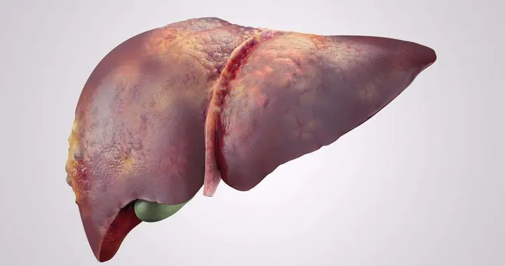 如何提前发现肝纤维化，盯好这 3 个指标，若异常抓紧干预还不晚