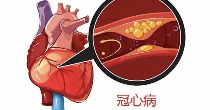 医生建议：冠心病患者坚持低盐饮食，1 个月后血压血管状态有 2 改善