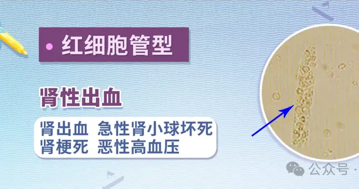 看懂你的尿常规化验单：这几项指标阳性，可能提示什么疾病？