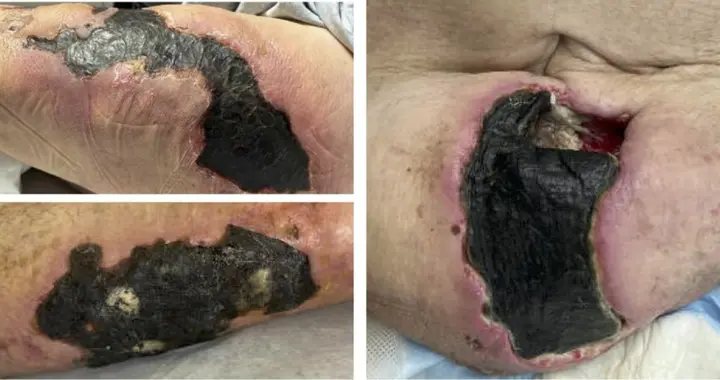 皮肤发黑、溃烂、长小疙瘩……透析患者要警惕这一并发症！