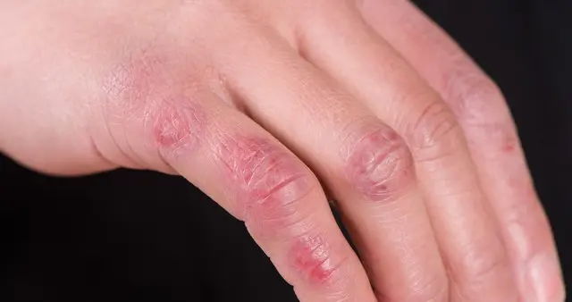 身上起湿疹别硬扛，这1个中成药，药店一般不会主动告诉你