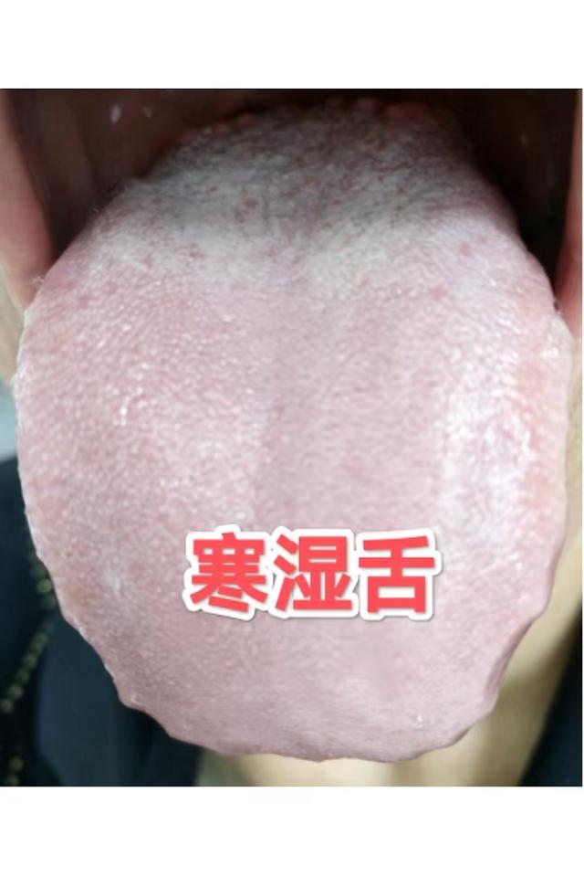 舌诊案例——30S辨别寒湿、痰湿、湿热！内附三名方 横扫一身湿邪
