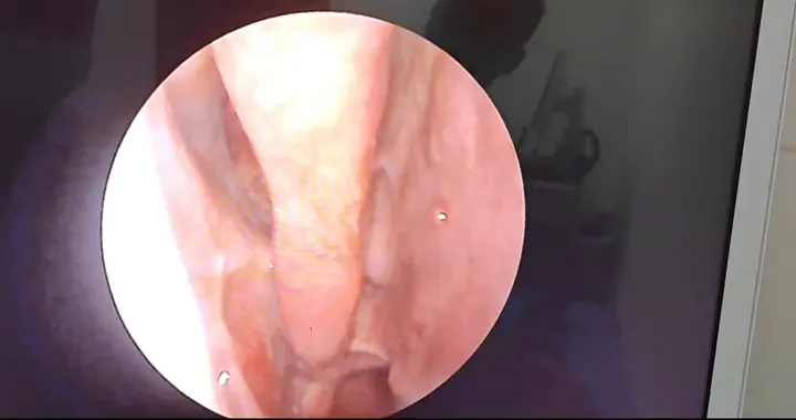 鼻息肉手术半年复查，恢复良好！