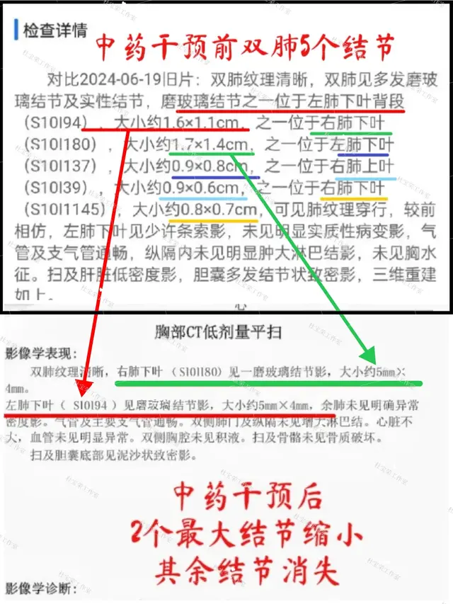 花6万切出来炎性肉芽肿，半年后又长新的。肺结节只能等着切？