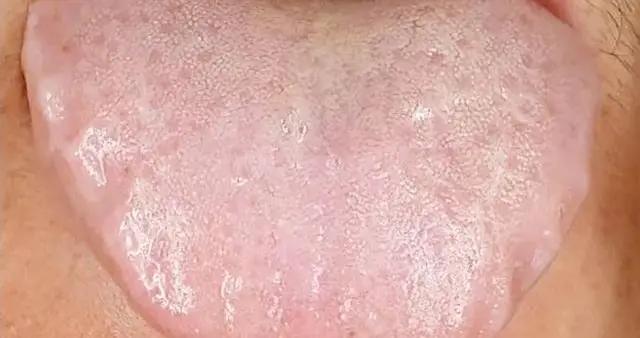 10天消囊肿结节患者的齿痕舌，别再说湿气祛不掉，囊肿结节散不了