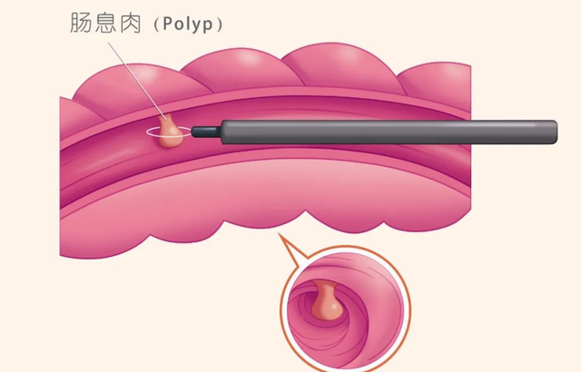一个中药方，专门针对胆囊息肉、胆结石，用了很多年从未失手！