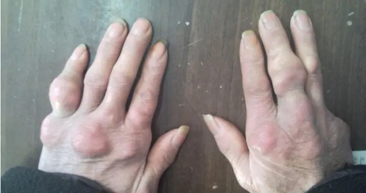 痛风离世的患者日益增多！医生多次告诫：少吃牛肉，多吃这几样