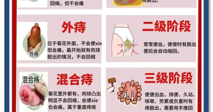痔疮“报警”：到了哪一期，别再硬扛该看医生了？