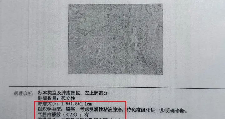 70岁浸润性肺腺癌，2年肺结节病史，无靶点——病理报告解读