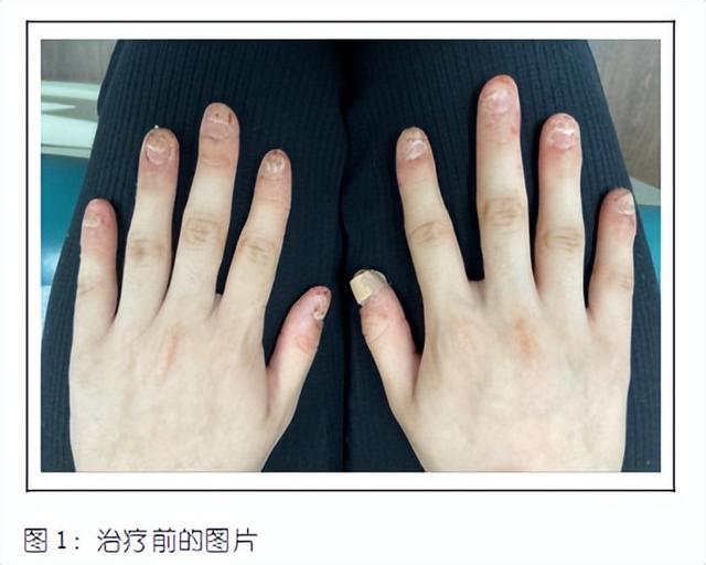 用Bimekizumab治疗连续性肢端皮炎的病例报告
