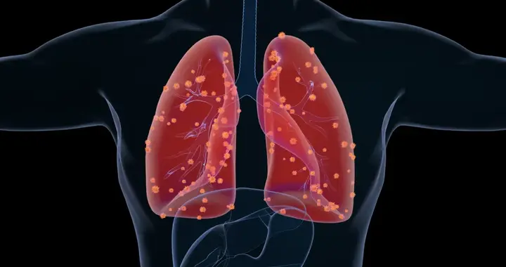 肺癌最怕遇到它，治疗小细胞肺癌，可能跟你想的不一样