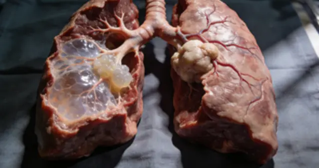 总久坐憋气入睡，肺通气不足，易诱发慢阻肺，别忽视