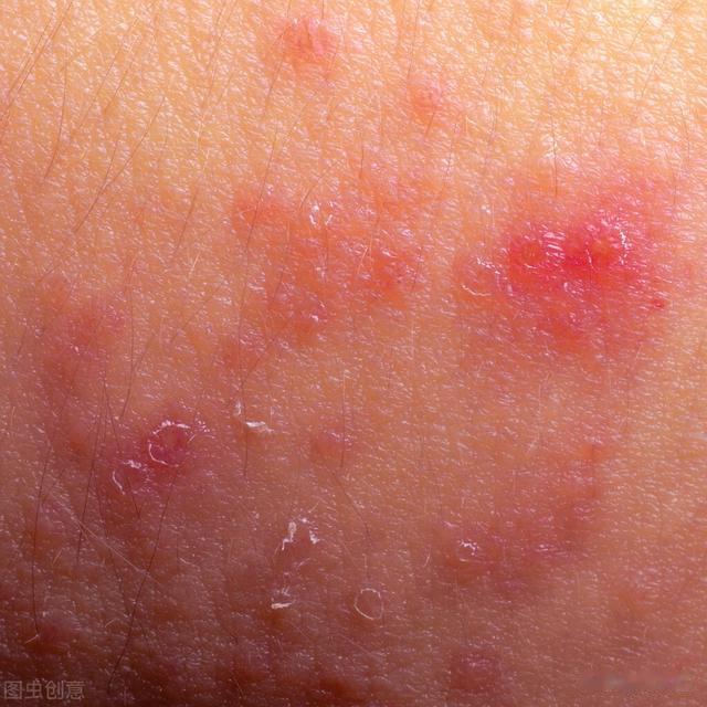 湿疹|湿热，湿疹，身热不扬，皮肤瘙痒，有一中成药很对症