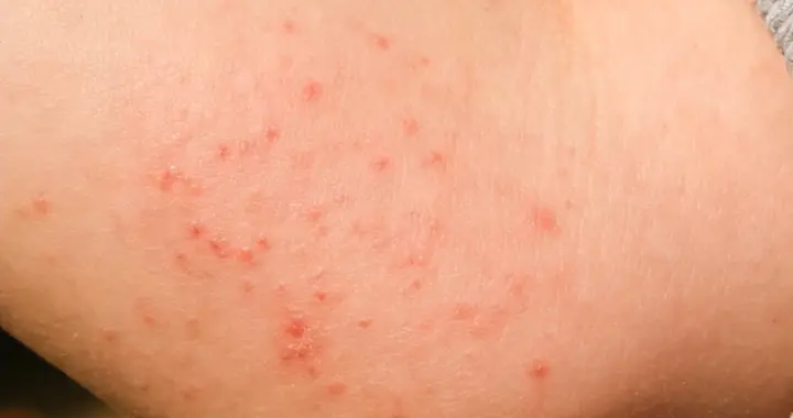 湿疹频现、皮肤总痒？中医辨证祛湿，帮你找回光滑健康肌