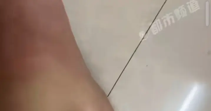 网友一句提醒救了命！外卖小哥脚肿一查竟是尿毒症晚期