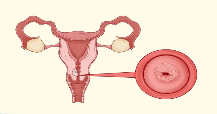 宫颈癌最先疼痛部位！医生提醒：这3个部位疼，别当成普通炎症