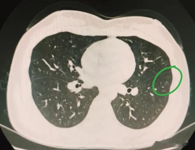 刘懿博士说肺癌（八九五八）6mm肺GGN三年前就有，只不过没这么大