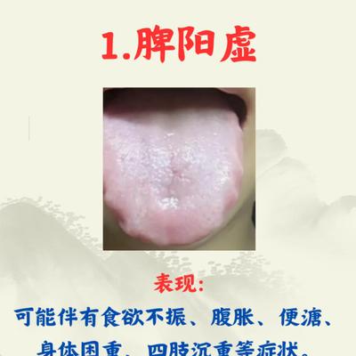 正能量的刘医生：齿痕舌的 5 种常见证型