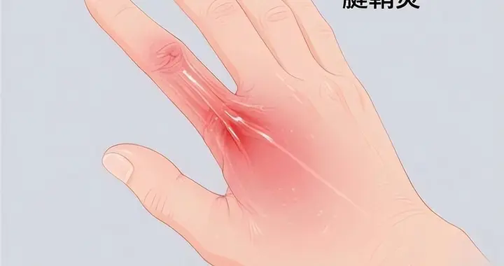 手腕咔咔响，别以为老了，5类人群小心腱鞘炎，4类症状及时就医