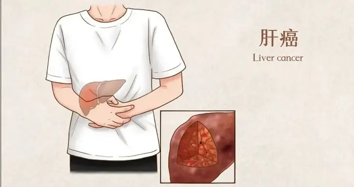 全球首款肝癌TIL疗法：6周肿瘤缩半，18周病灶全消，162天的逆袭