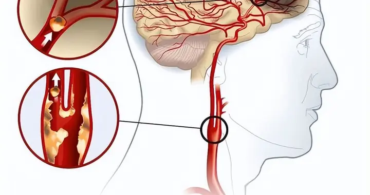 为什么现在脑梗越来越多？医生提醒：饭后少做4件事，劝你改正