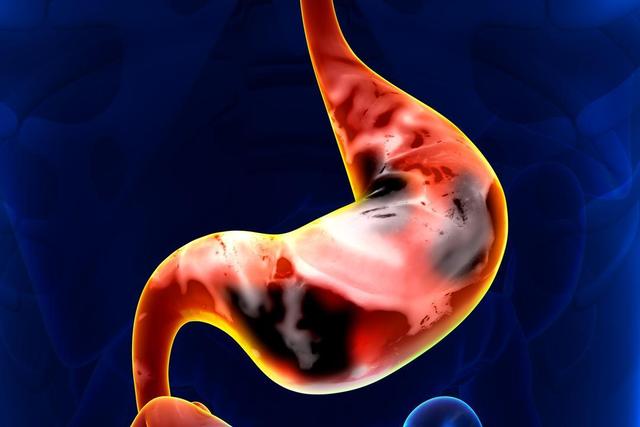 全球一半胃癌在中国？柳叶刀：若想养胃，6物建议少吃，对胃好