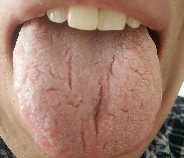舌头有裂纹，是大病征兆，2种裂纹舌，中医一次讲明白！