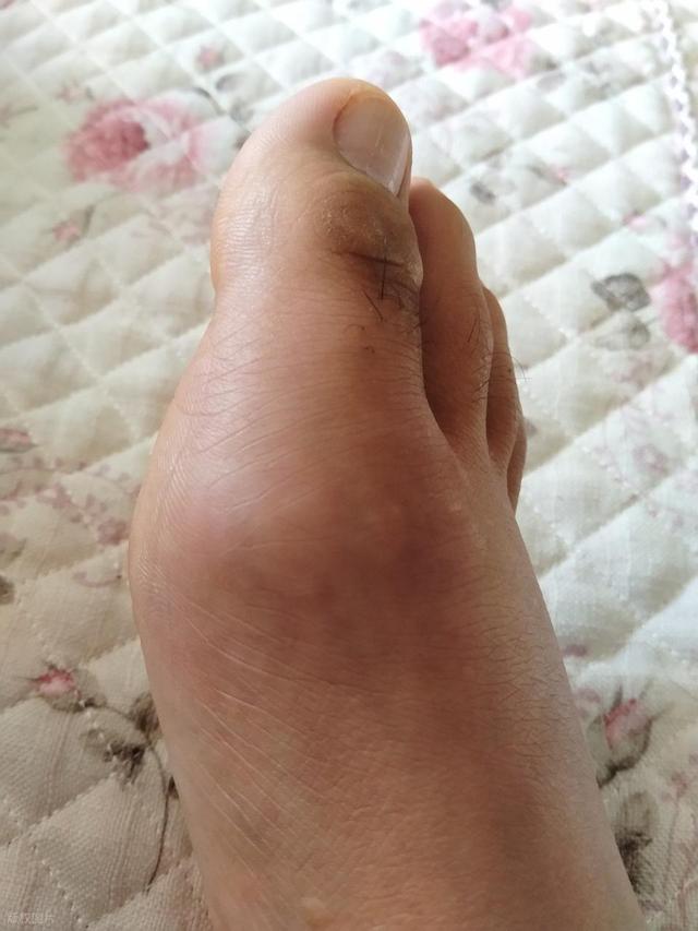 痛风有哪些有效的治疗方法？
