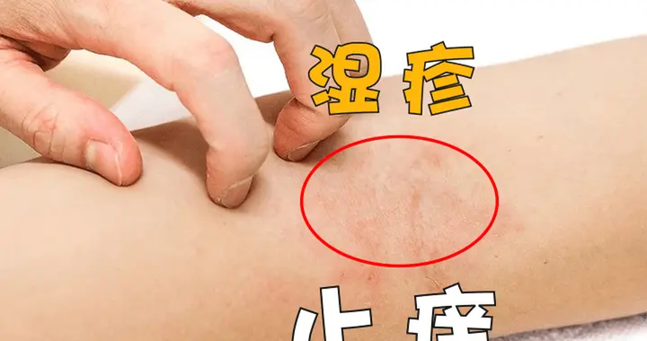 1中成药补气血，让湿疹不再反复瘙痒，摆脱十几年湿疹困扰