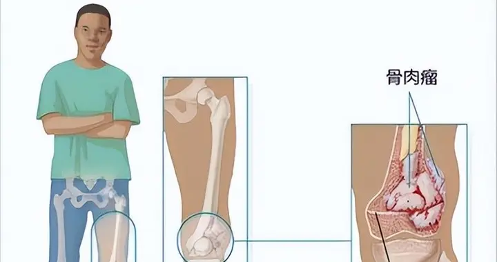 摸到骨头突起还发热？这5个体征速查骨癌风险