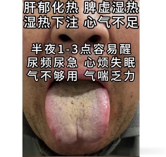 男科门诊3大典型：肾精亏虚，湿热下注，尿频尿急，疲软，异味大