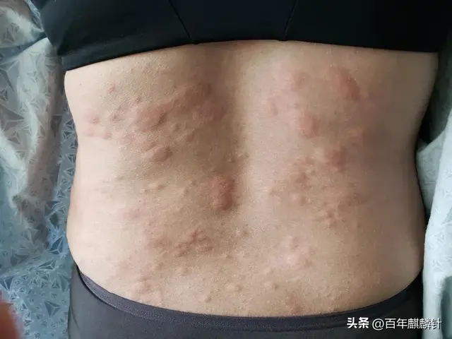 开阖枢失衡致隐疹——六经气化视角下的荨麻疹辨治与经方运用探索