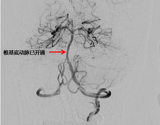 边复苏边手术！10分钟打通闭塞椎基底动脉，74岁老先生成功获救