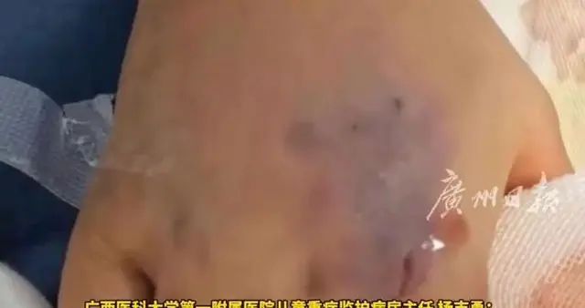 3岁女童遭眼镜王蛇咬伤假死3天，注射血清1小时奇迹苏醒