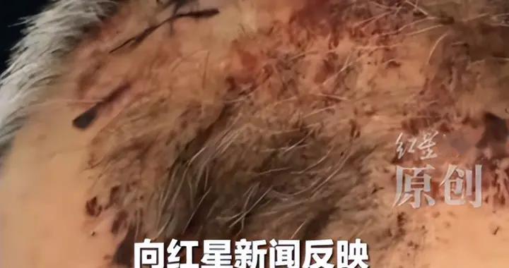 养老院老人被打，全身多处骨折，头缝9针，警方介入，后果很严重