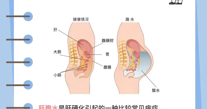 忽视肚子变大可能拖成肝腹水！肝病患者必看
