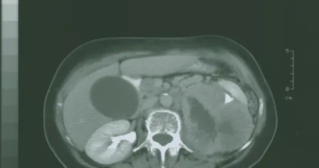 体检查出这五种肝病，其实基本不用治，纯属自己吓自己