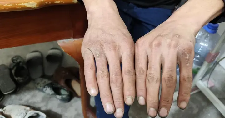 夜访90后农民工：200块的出租屋，皮开肉绽的腿，没敢去的医院