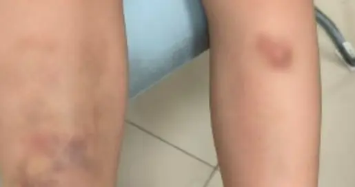 央视曝光！6岁男童吃生菜全身青斑，血小板失灵，真凶竟是它